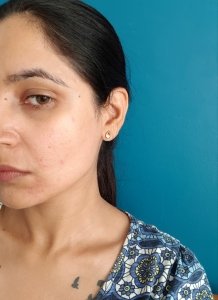 No Makeup side (on bad skin day with redness and rash)