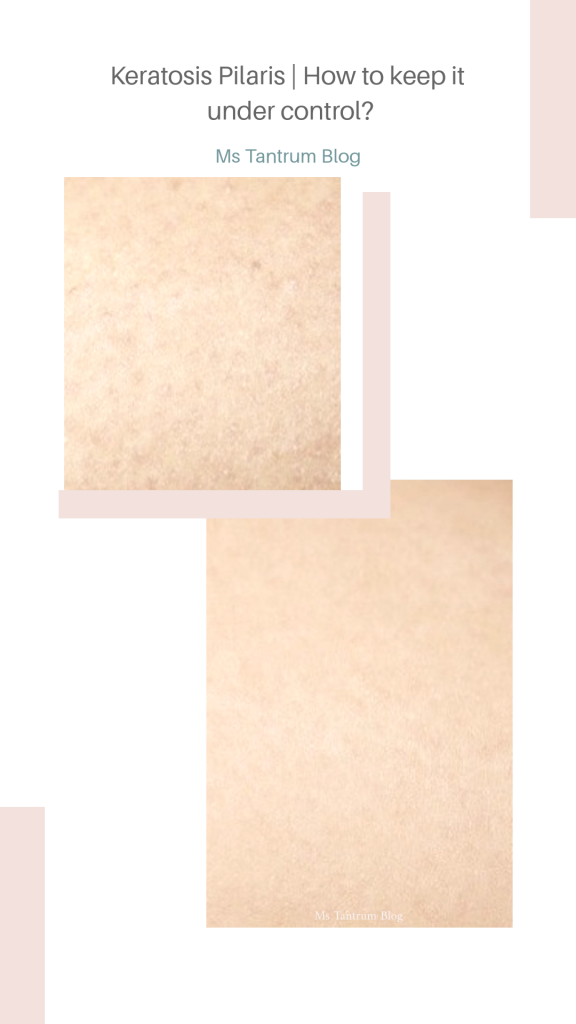 How to keep Keratosis Pilaris under control?